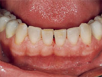 After cleaning with Prophyflex