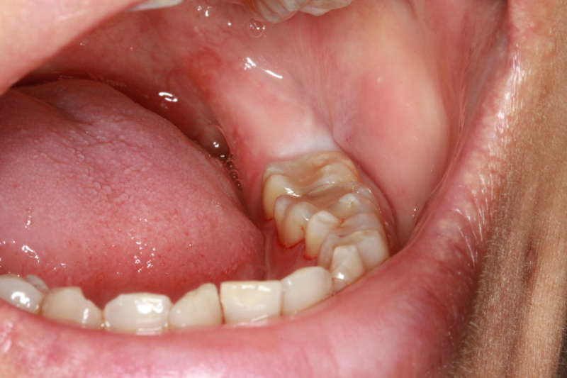 Fig 2 : Pre-operation