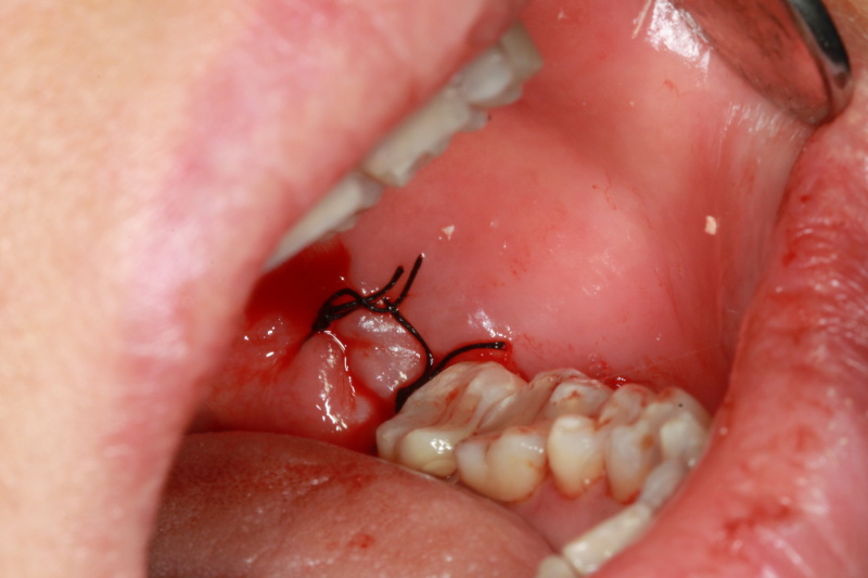 Fig 6 : Surgical wound closed with sutures