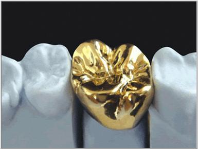 Full gold crown
