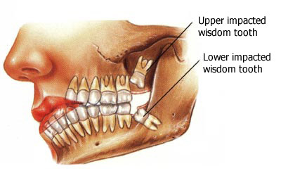 Impacted wisdom tooth
