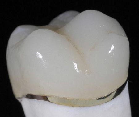 Porcelain fused to metal crown