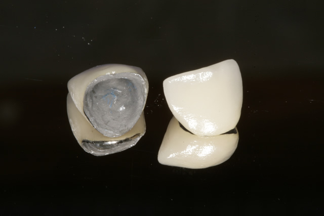 Porcelain fused to metal (fitting surface)