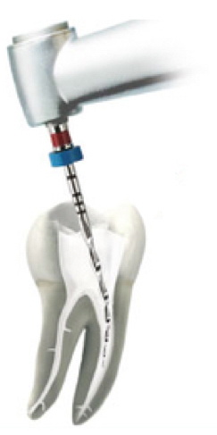 Root Canal Treatment
