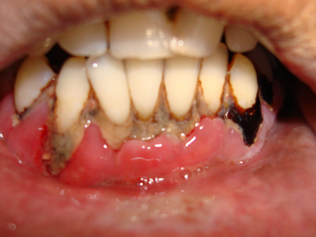 Advanced periodontitis