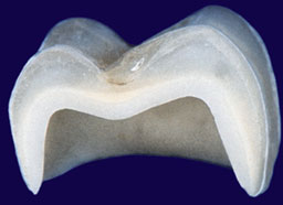 Full Ceramic Crown (Procera)
